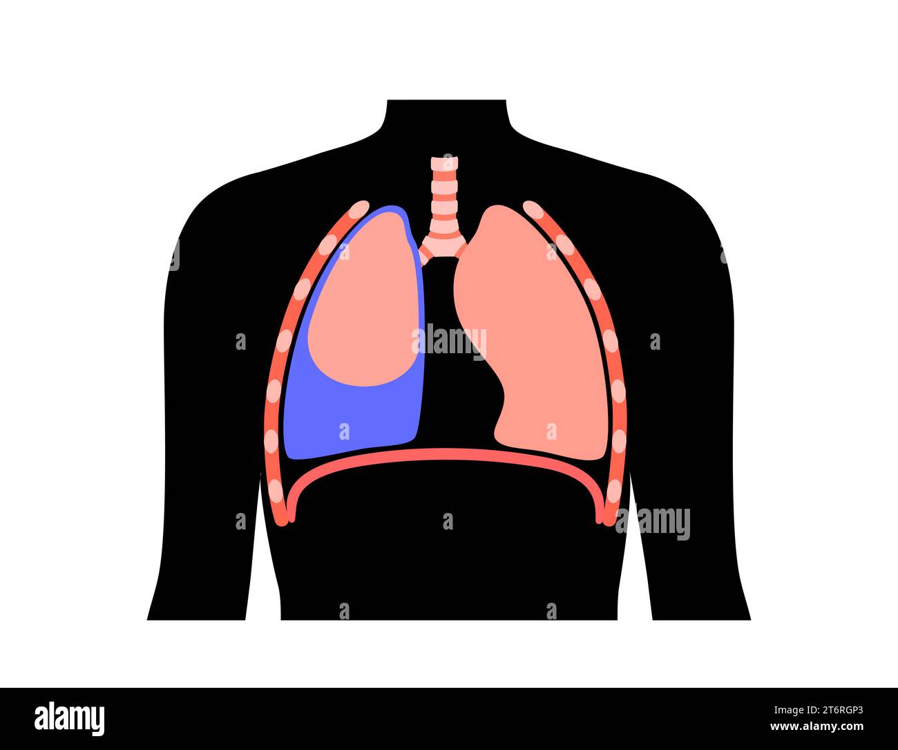 Épanchement pleural, illustration Banque D'Images