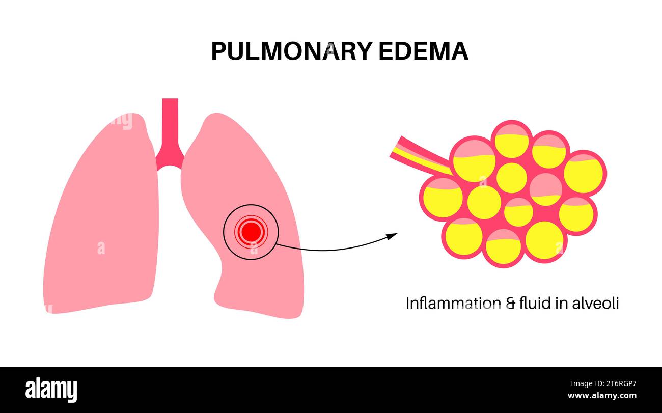 Oedème pulmonaire, illustration Banque D'Images