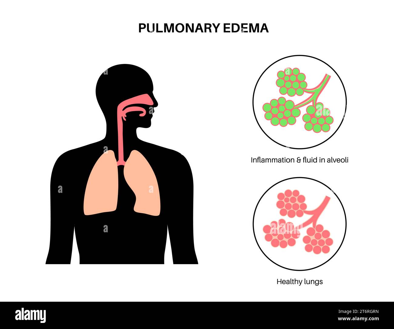 Oedème pulmonaire, illustration Banque D'Images