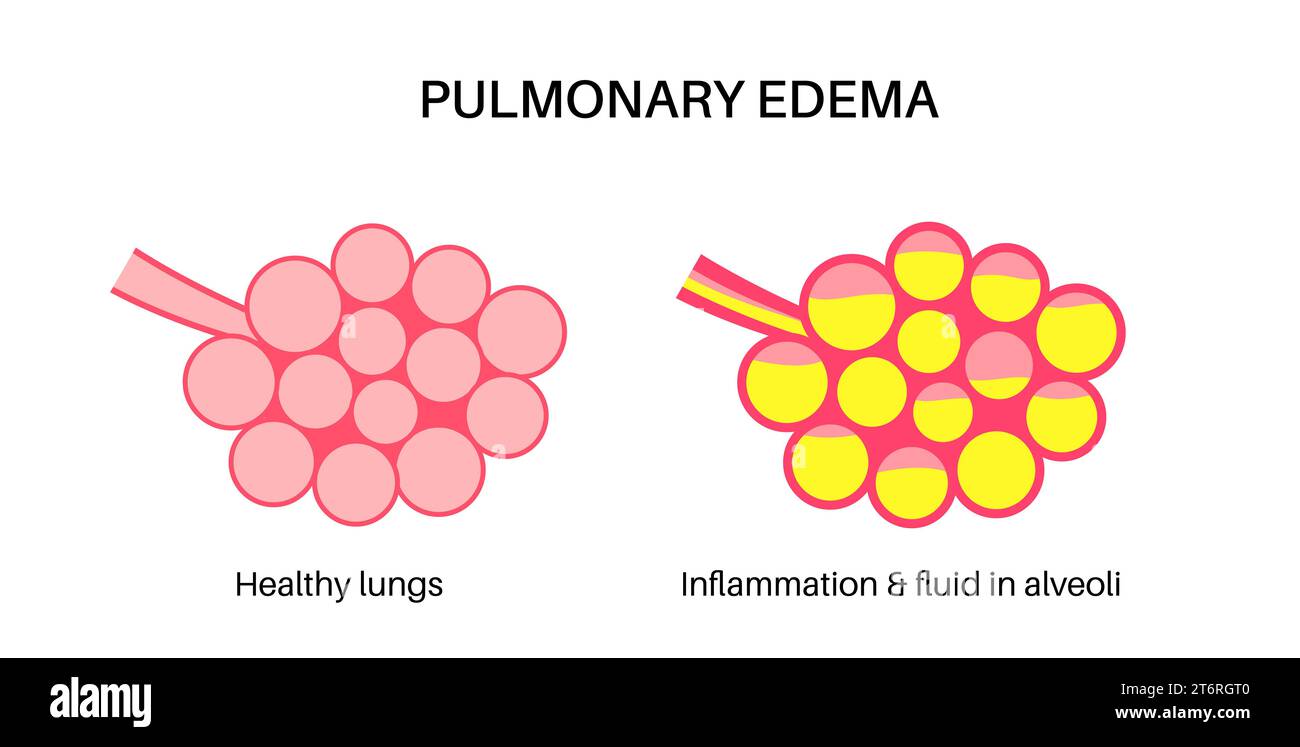 Oedème pulmonaire, illustration Banque D'Images