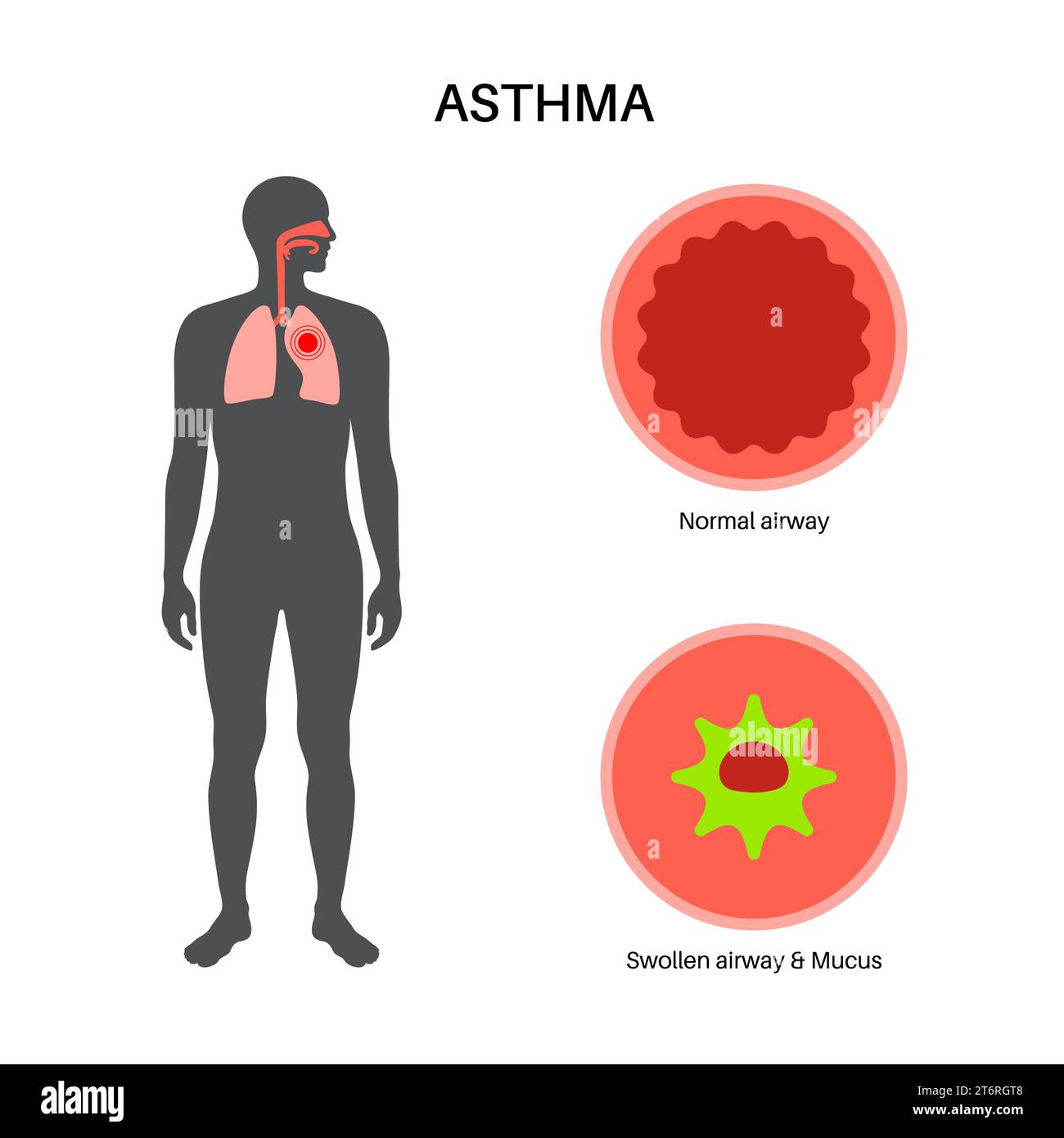 Asthme, illustration Banque D'Images