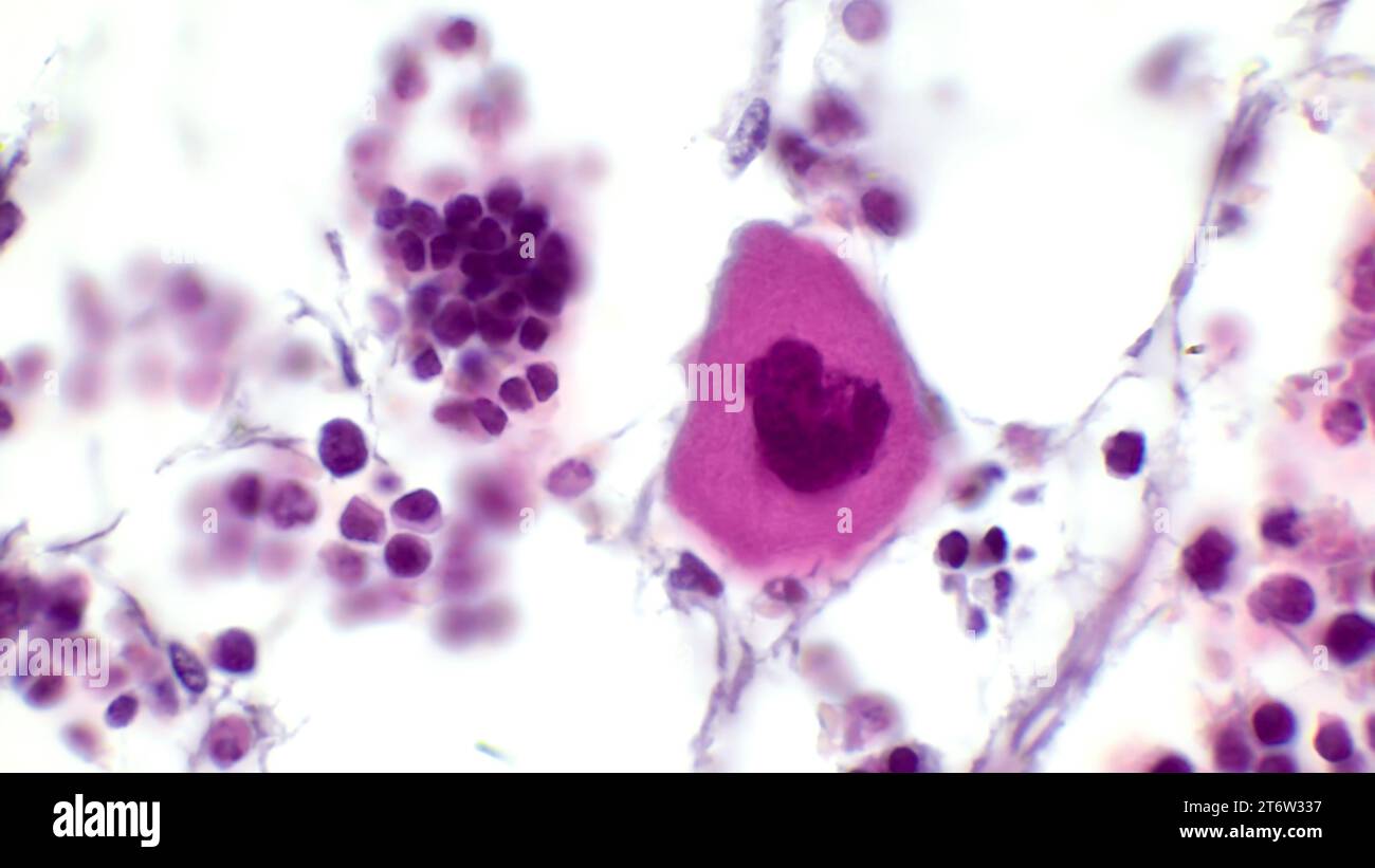 Mégacaryocyte dans la moelle osseuse rouge. Coloration à l'hématoxyline et à l'éosine. Grossissement - 1000. Banque D'Images
