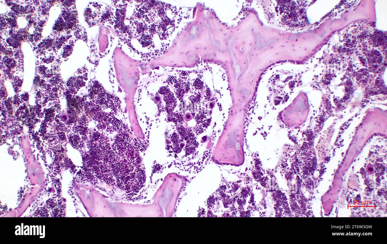 Moelle osseuse rouge humaine, presse hématopoïétique. Les érythrocytes de gros tsit beetveen sont des mégacaryocytes. Coloration à l'hématoxyline et à l'éosine. Banque D'Images