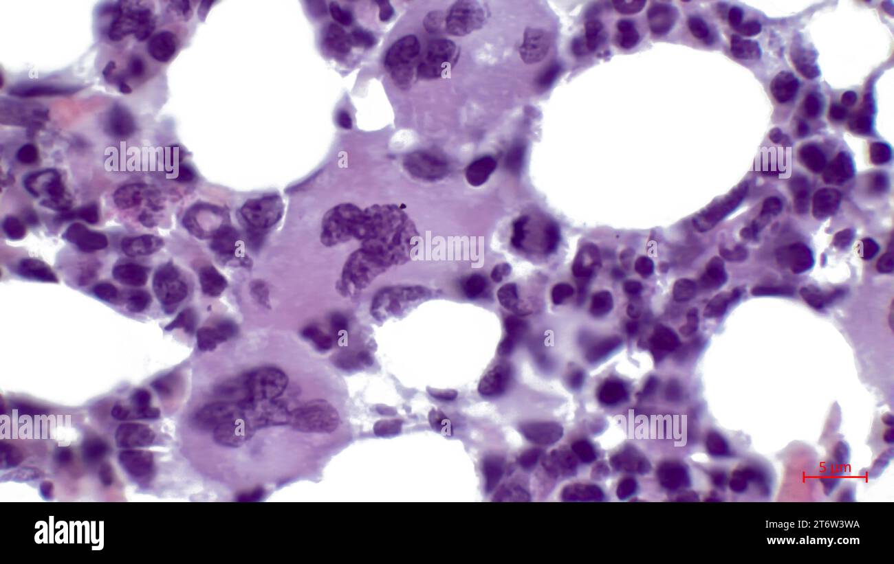 Moelle osseuse rouge, micrographie légère. Il se compose principalement de tissu hématopoïétique, où les cellules sanguines sont créées. Au centre se trouvent trois mégacaryocytes. Banque D'Images