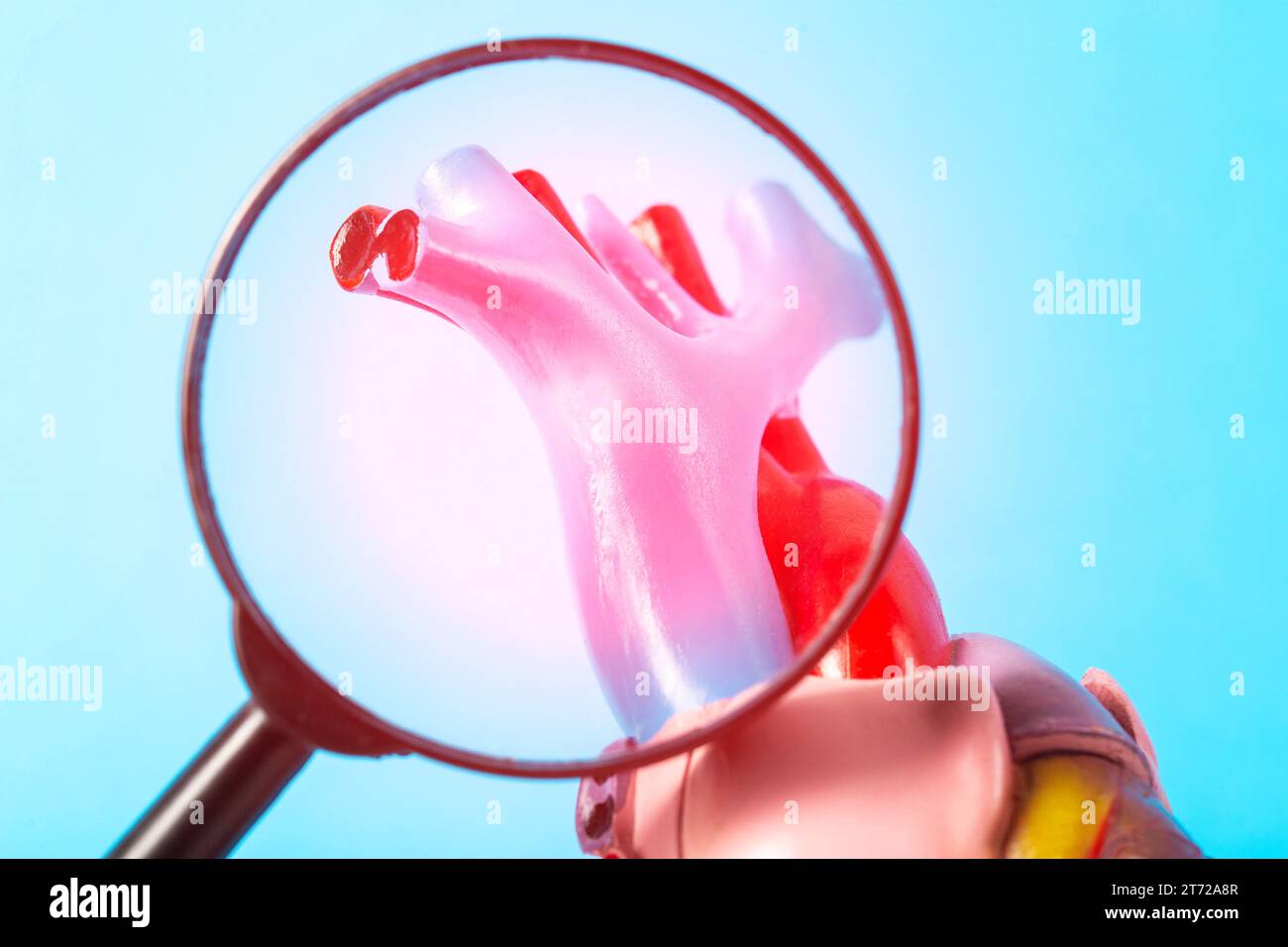 Artères coronaires enflammées du coeur sous une loupe sur fond bleu. Conception de l'athérosclérose des artères coronaires de l'oreille Banque D'Images