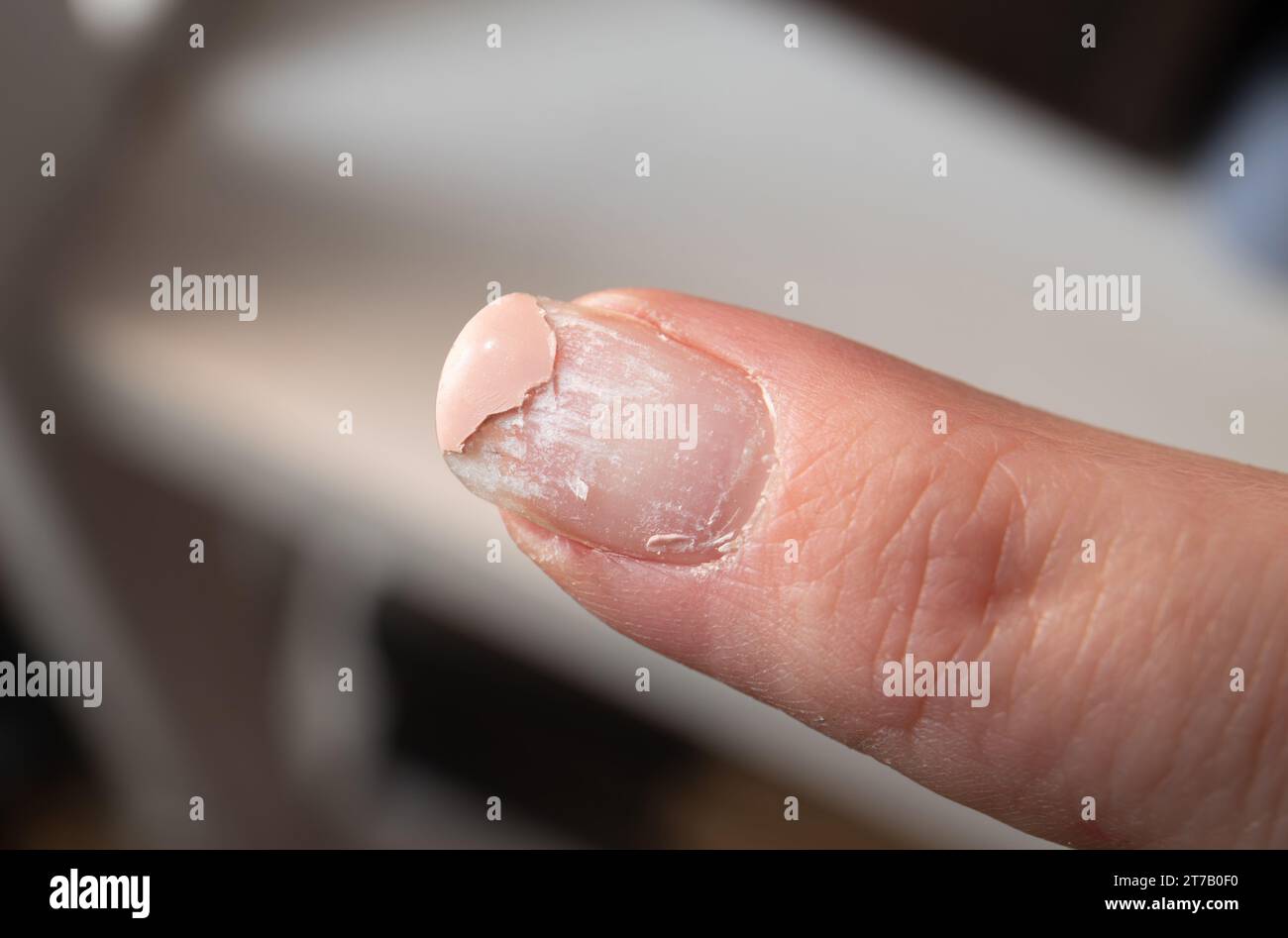 Vue rapprochée des couches décollant l'ongle endommagé après l'utilisation de vernis à ongles UV. Maison à l'intérieur. Banque D'Images