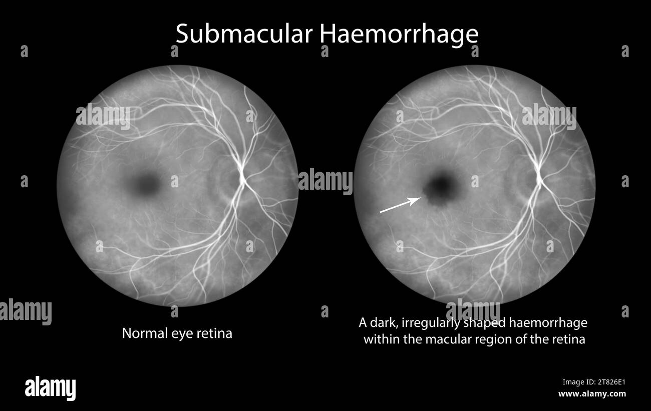 Illustration d'une hémorragie sous-maculaire observée en angiographie à la fluorescéine, mettant en évidence une hémorragie sombre et de forme irrégulière au sein du reg. Maculaire Banque D'Images