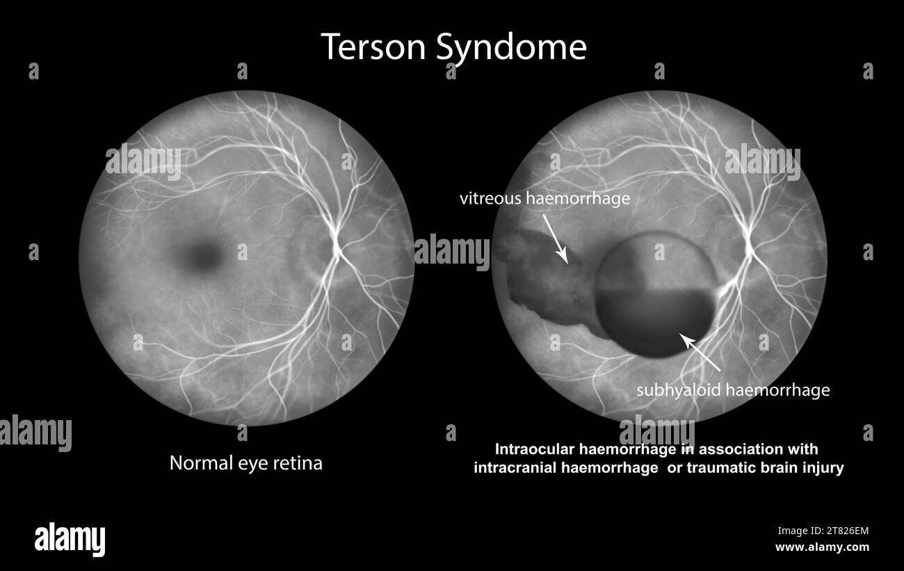 Illustration représentant un syndrome de Terson, révélant une hémorragie intraoculaire observée lors d'une angiographie fluorescéinique, liée à une hémorragie intracrânienne Banque D'Images