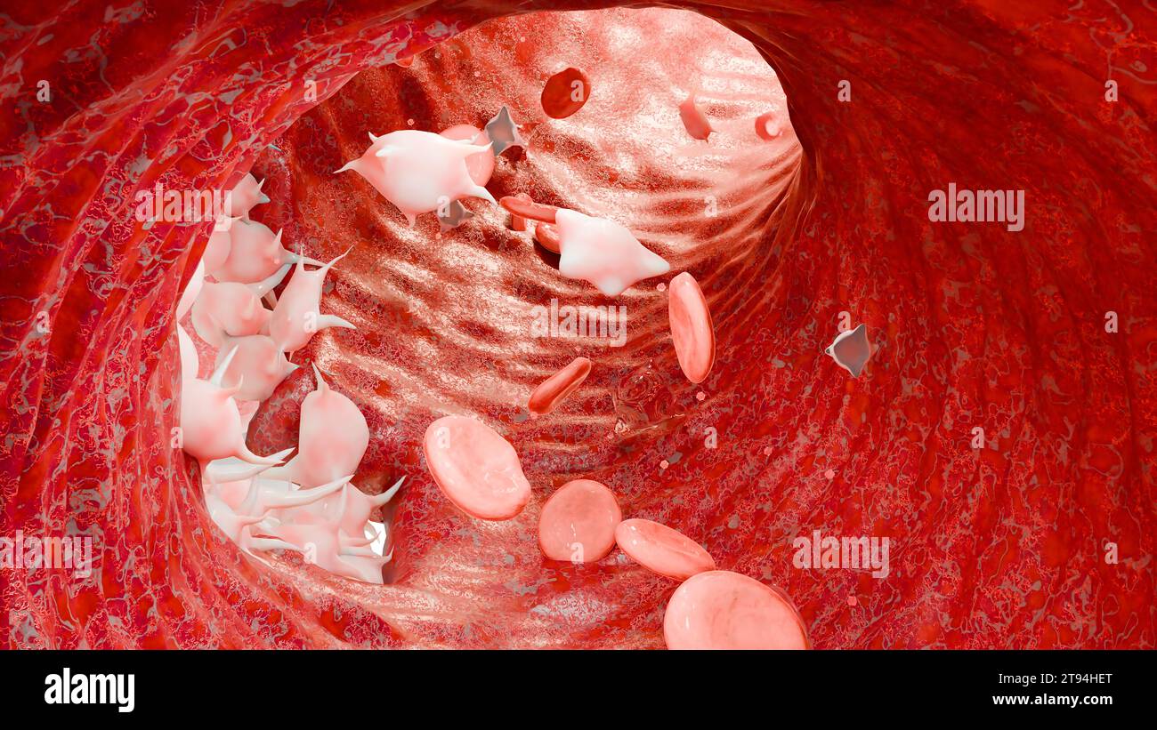 Hémostase. Globules rouges et plaquettes dans le vaisseau sanguin, vasoconstriction, processus de cicatrisation. Embolies de caillots hémorragiques, hémophilie. fibrino Banque D'Images