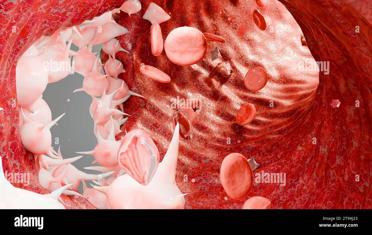 Hémostase. Globules rouges et plaquettes dans le vaisseau sanguin, vasoconstriction, processus de cicatrisation. Embolies de caillots hémorragiques, hémophilie. fibrino Banque D'Images