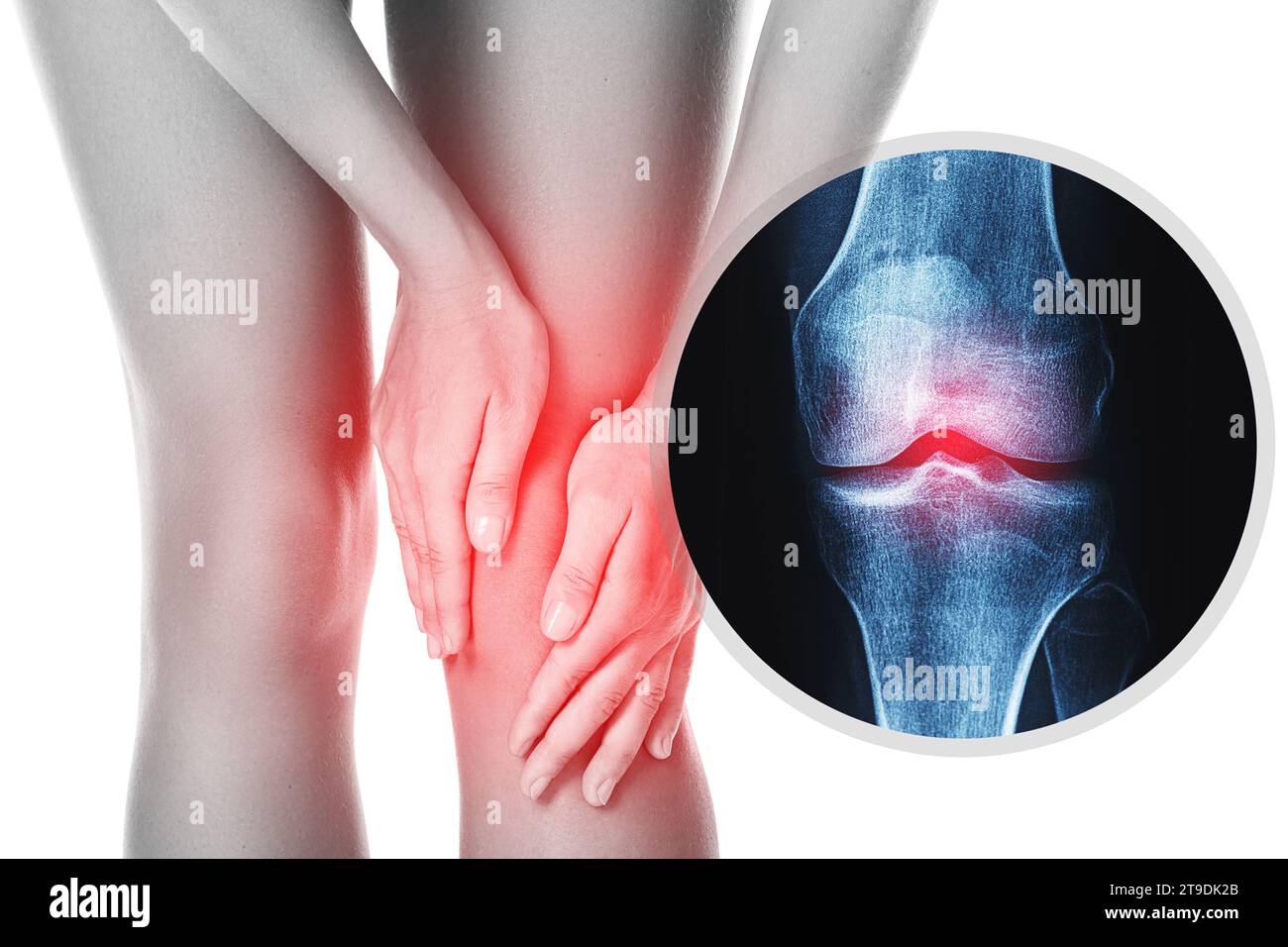 Genou féminin et effet radiographique avec articulation blessée Banque D'Images