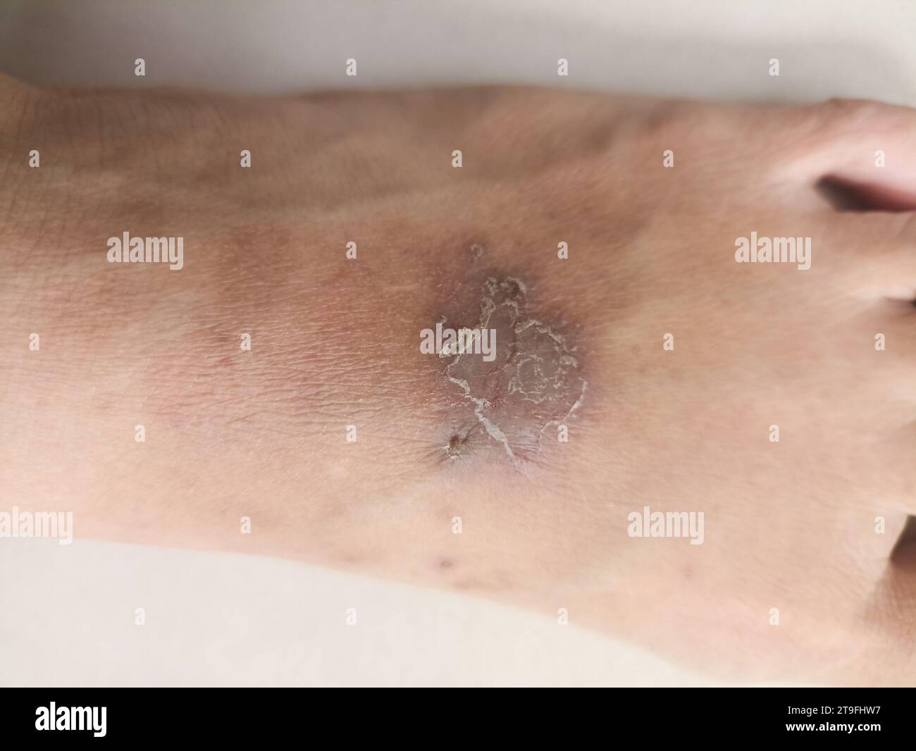 rash eczéma dermatite au pied. inflammation de la peau Banque D'Images
