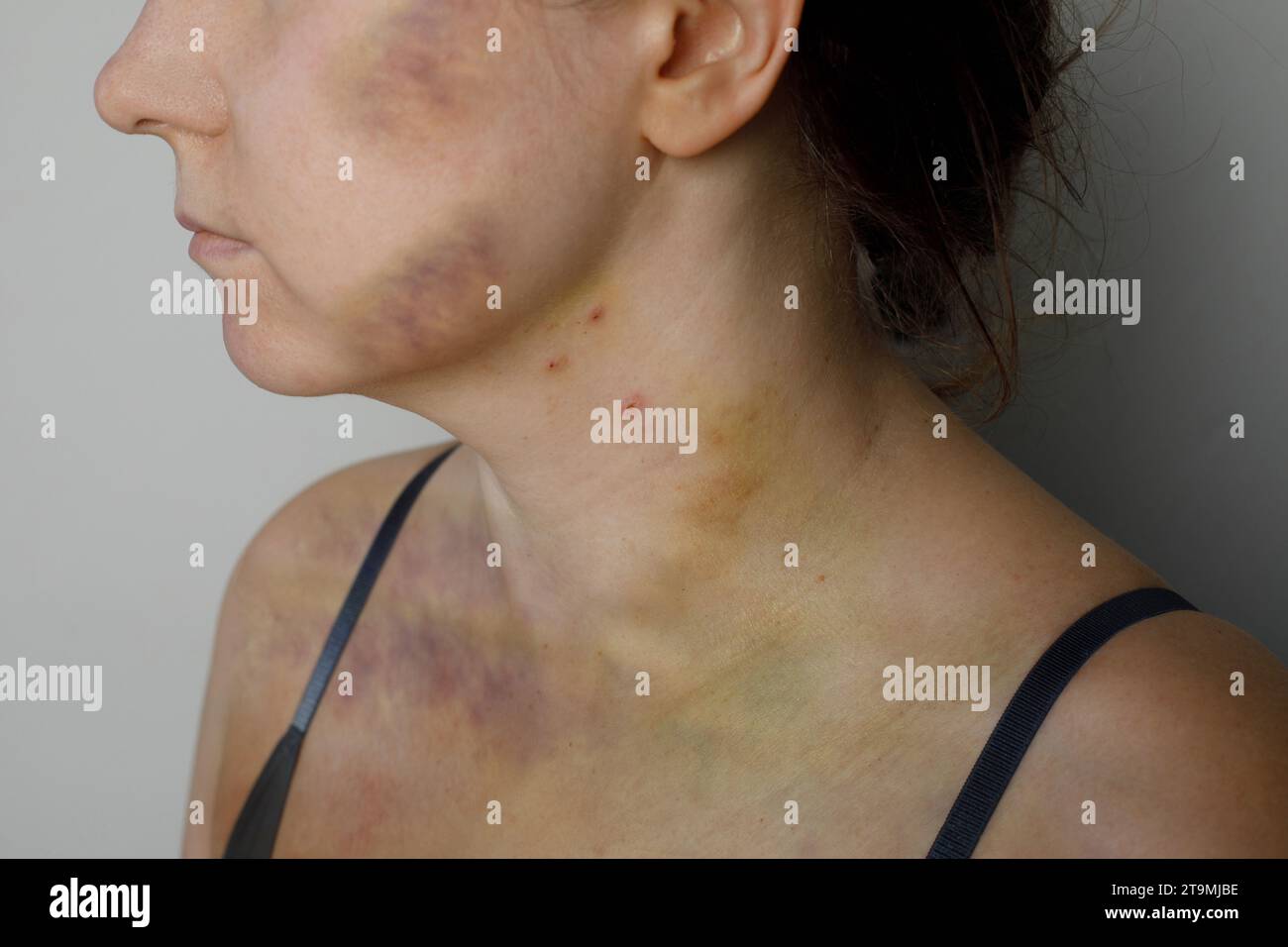 Cicatrice d'accident de voiture, traitement de l'embolie pulmonaire ou concept de soutien à la violence domestique. Femme avec ecchymose et cicatrice gros plan Banque D'Images