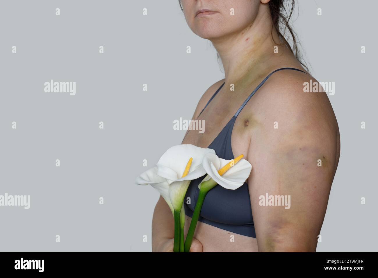 Jeune femme avec des bleus et fleur de lys blanc gros plan sur fond gris. Cicatrice d'accident de voiture, traitement de l'embolie pulmonaire ou violence domestique Banque D'Images