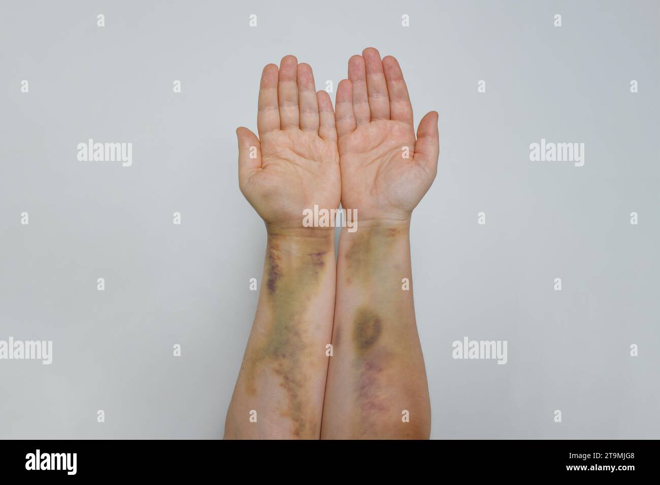 Main féminine avec peau contusionnée. Bras avec ecchymose gros plan sur fond gris Banque D'Images