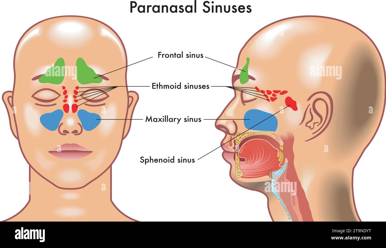 Illustration médicale des symptômes de sinusite. Illustration de Vecteur