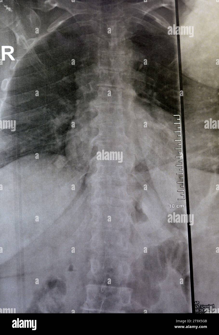 Une radiographie simple de la colonne vertébrale dorsale et lombaire révèle des modifications spondylotiques, un redressement de la colonne dorsale et lombaire, des espaces discaux intervertébraux intacts, Banque D'Images