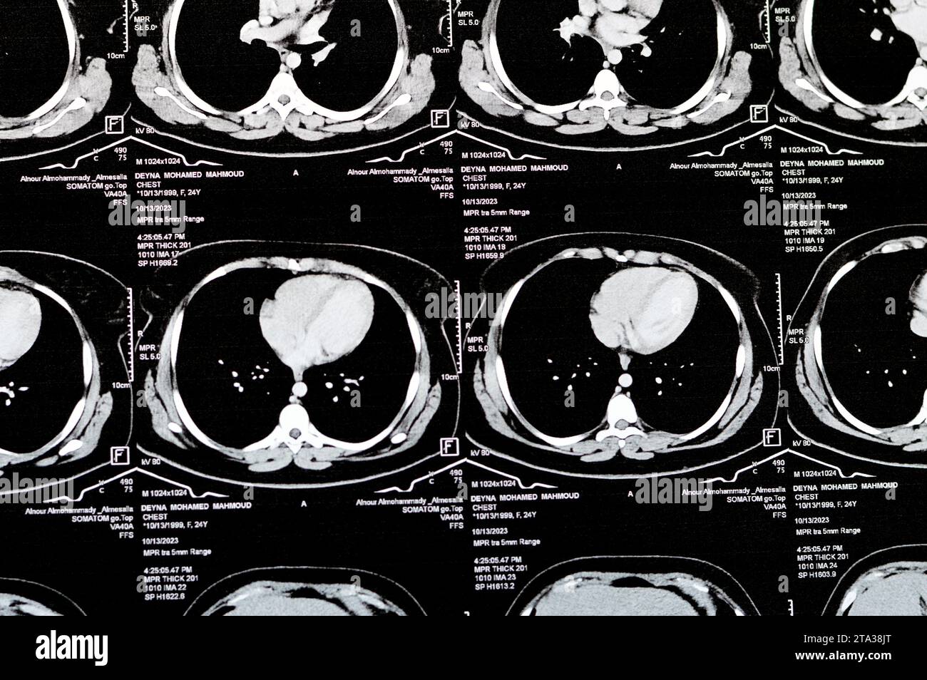 Le Caire, Égypte, octobre 15 2023 : tomodensitométrie en coupes axiales à travers le thorax avec injection de produit de contraste montrant un faible degré de réaction inflammatoire, esv parenchymateuse Banque D'Images