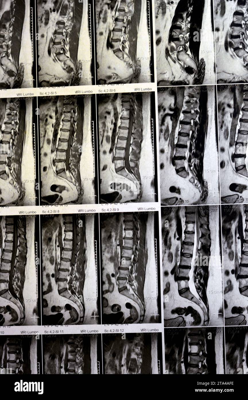 IRM rachis lombo-sacré sans produit de contraste a révélé un spasme musculaire du dos, de légères lésions discales L3-L4, L4-L5, hémangiome des vertèbres sacrées, L5 et T12, Banque D'Images