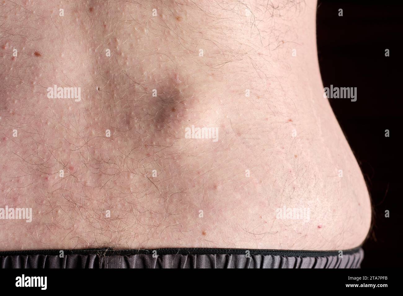 Petit lipome rond sur le bas du dos d'un jeune homme caucasien sur fond noir foncé. Banque D'Images