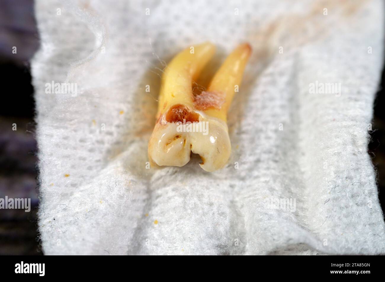 Sagesse extraite 8e dent inférieure droite avec une carie dentaire, après avoir exposé le nerf et la douleur intense, l'enflure et l'inflammation, les dents de sagesse sont les molaires Banque D'Images