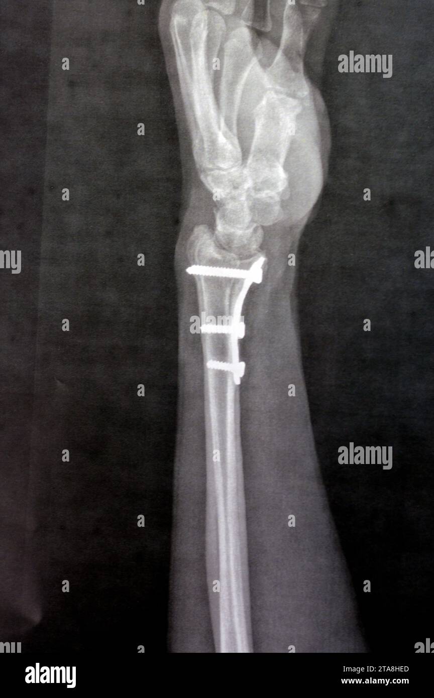 Radiographie simple montrant une fracture récente de fissure à la partie inférieure d'un os du RADIUS gauche, montrant également une fixation interne antérieure du poignet joint Wit Banque D'Images