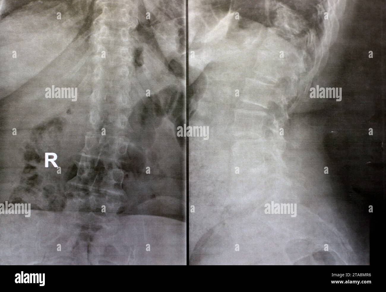 Une radiographie simple de la colonne vertébrale dorsale et lombaire révèle des modifications spondylotiques, un redressement de la colonne dorsale et lombaire, des espaces discaux intervertébraux intacts, Banque D'Images