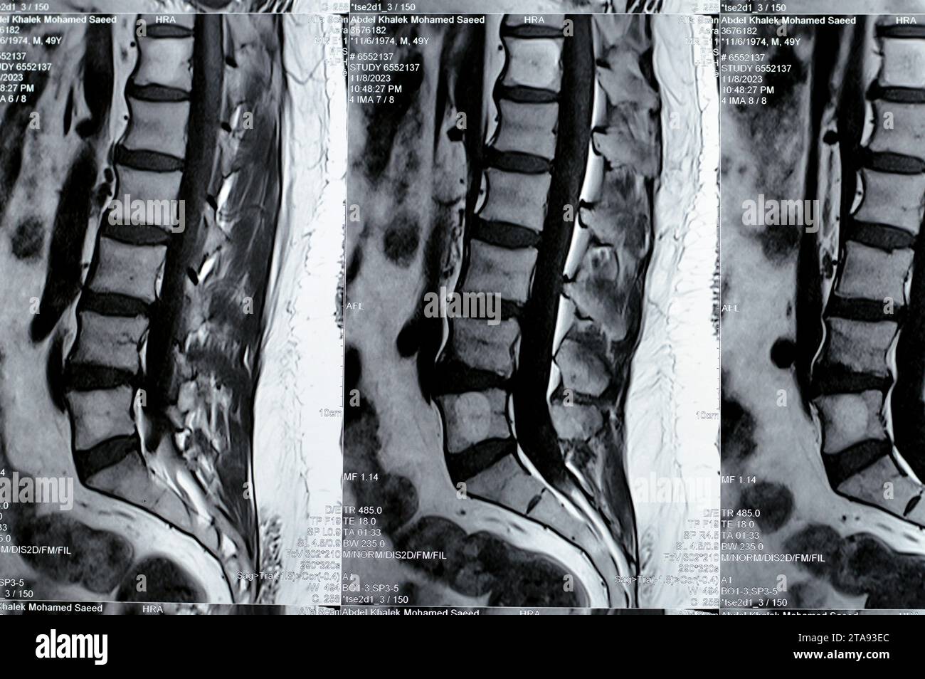 Le Caire, Egypte, novembre 14 2023 : IRM de la colonne vertébrale lombo-sacrée a révélé des renflements discaux postérieurs L3-L4, L4-L5, effaçant la graisse épidurale ventrale, indentant le Banque D'Images
