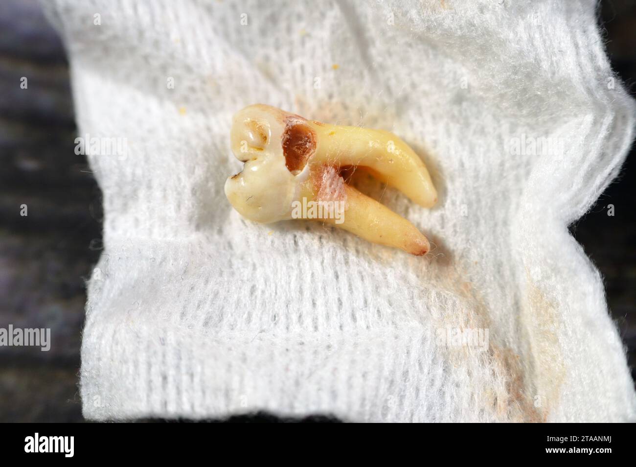 Sagesse extraite 8e dent inférieure droite avec une carie dentaire, après avoir exposé le nerf et la douleur intense, l'enflure et l'inflammation, les dents de sagesse sont les molaires Banque D'Images