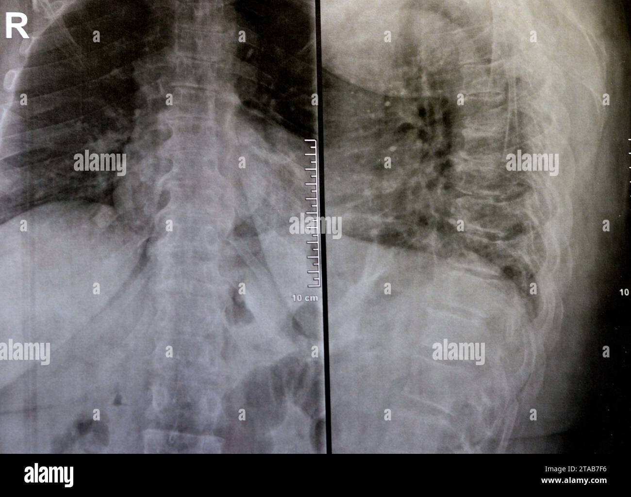 Une radiographie simple de la colonne vertébrale dorsale et lombaire révèle des modifications spondylotiques, un redressement de la colonne dorsale et lombaire, des espaces discaux intervertébraux intacts, Banque D'Images