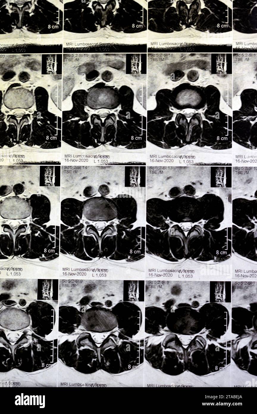 IRM rachis lombo-sacré sans produit de contraste a révélé un spasme musculaire du dos, de légères lésions discales L3-L4, L4-L5, hémangiome des vertèbres sacrées, L5 et T12, Banque D'Images