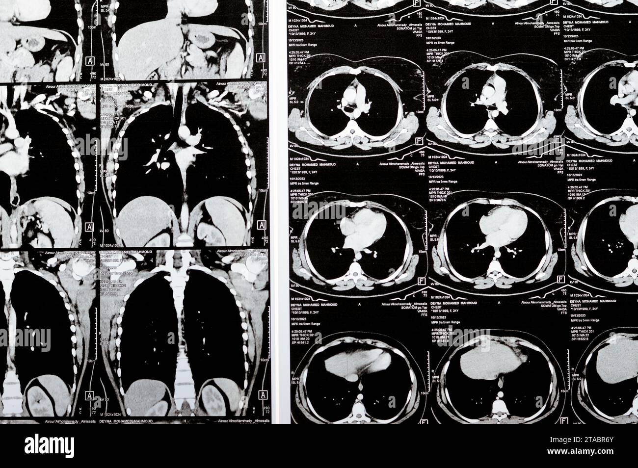 Le Caire, Égypte, octobre 15 2023 : tomodensitométrie en coupes axiales à travers le thorax avec injection de produit de contraste montrant un faible degré de réaction inflammatoire, esv parenchymateuse Banque D'Images
