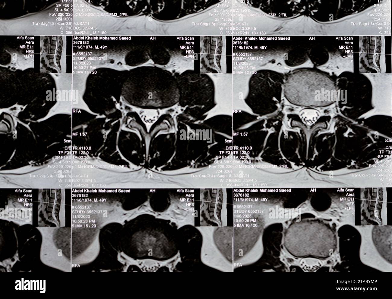 Le Caire, Egypte, novembre 14 2023 : IRM de la colonne vertébrale lombo-sacrée a révélé des renflements discaux postérieurs L3-L4, L4-L5, effaçant la graisse épidurale ventrale, indentant le Banque D'Images