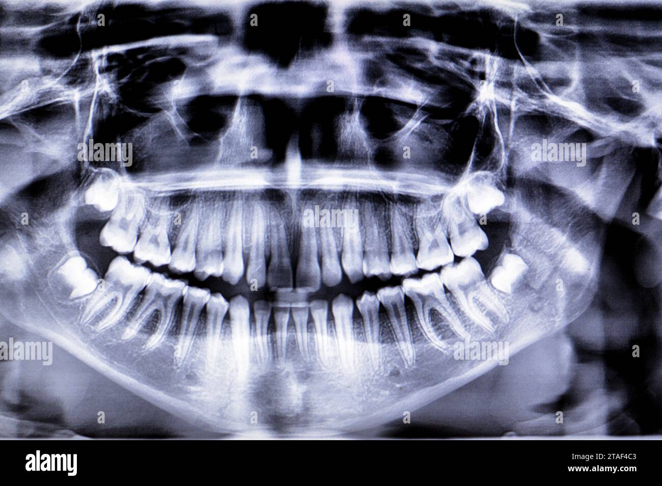 Radiographie panoramique d'une fracture de la mâchoire chez une fille après un traumatisme direct du côté gauche, radiographie dentaire panoramique du haut et du bas Banque D'Images