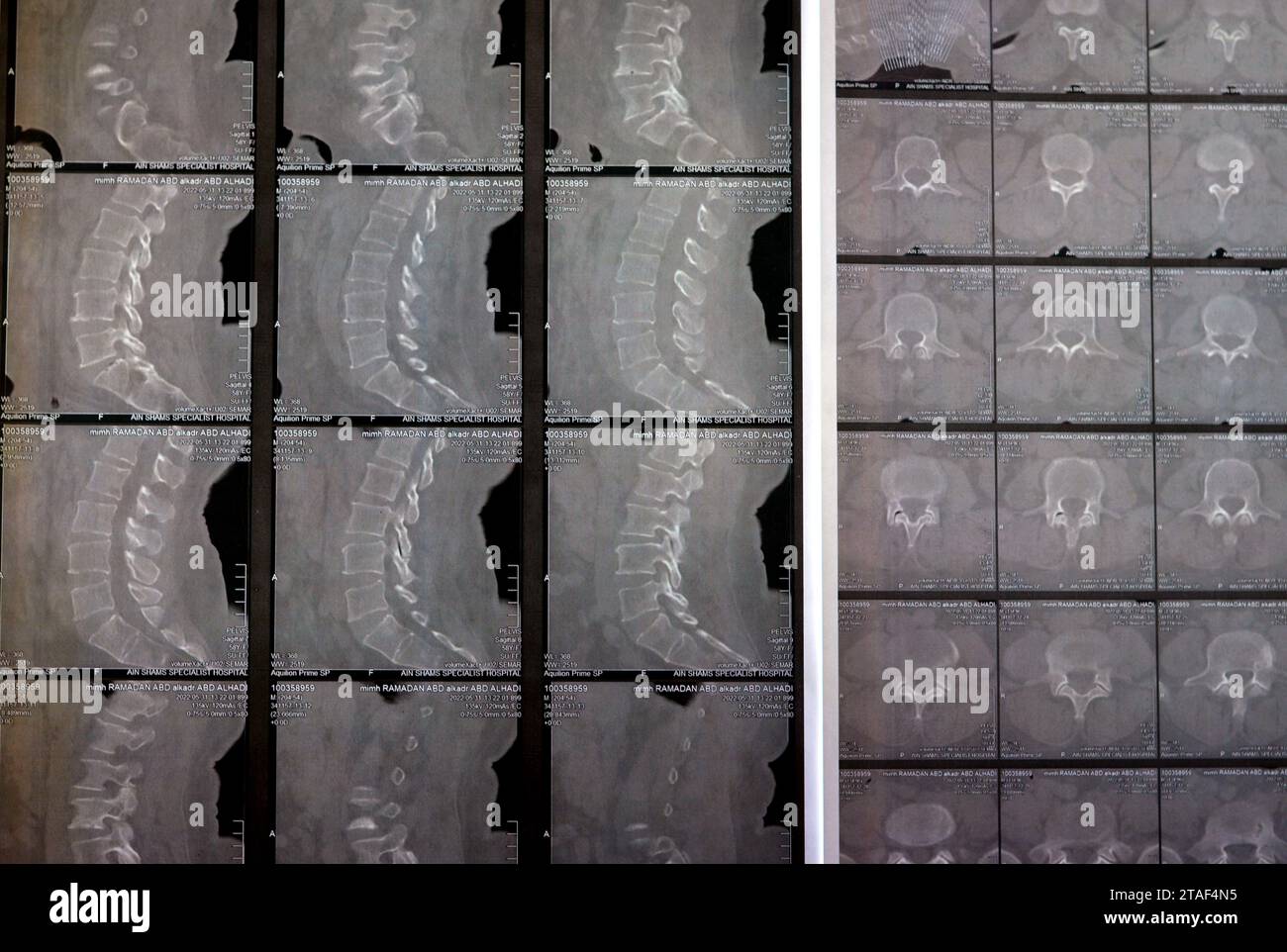 Le Caire, Egypte, octobre 15 2023 : la tomodensitométrie de la colonne lombo-sacrée révèle des modifications spondylotiques du bois, des renflements discaux diffus L4-L5, L5-S1, des facettes joi bilatérales Banque D'Images
