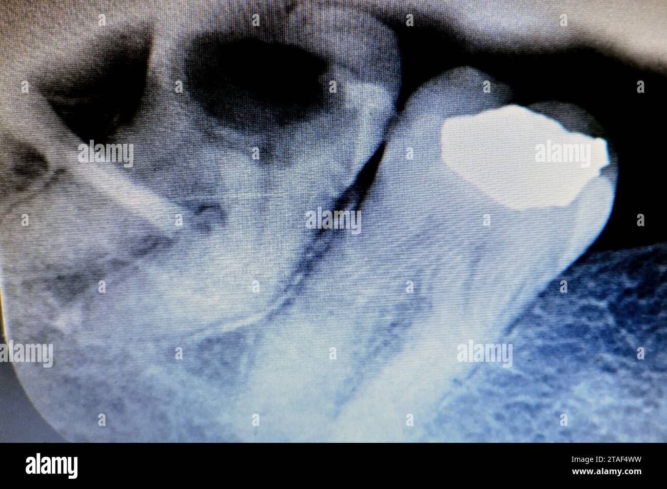 Rayon X sur la sagesse 8e dent inférieure droite avec une carie dentaire, après avoir exposé le nerf et la douleur intense, l'enflure et l'inflammation, les dents de sagesse sont les molaires Banque D'Images