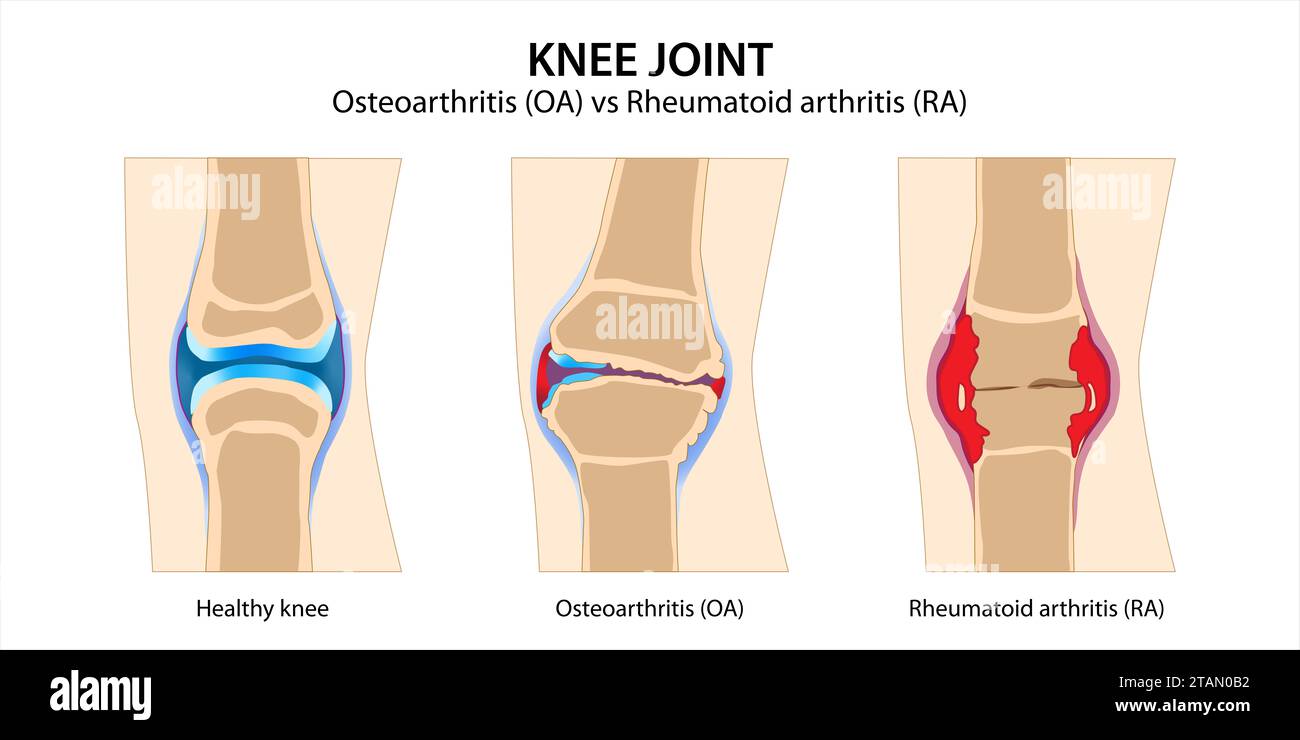 Arthrose du genou vs polyarthrite rhumatoïde Banque D'Images