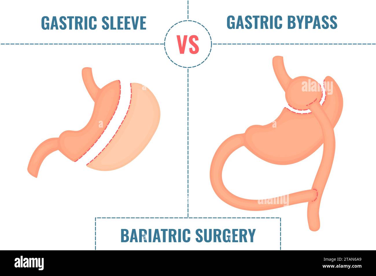 Chirurgie bariatrique, illustration conceptuelle Banque D'Images