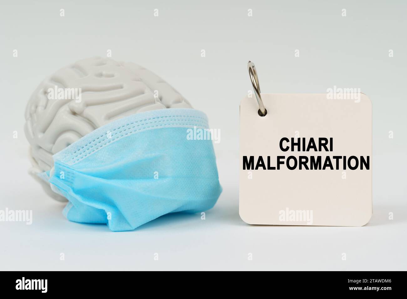 Concept médical. Sur une surface blanche, il y a un cerveau avec un masque bleu et un bloc-notes avec l'inscription - malformation de Chiari Banque D'Images