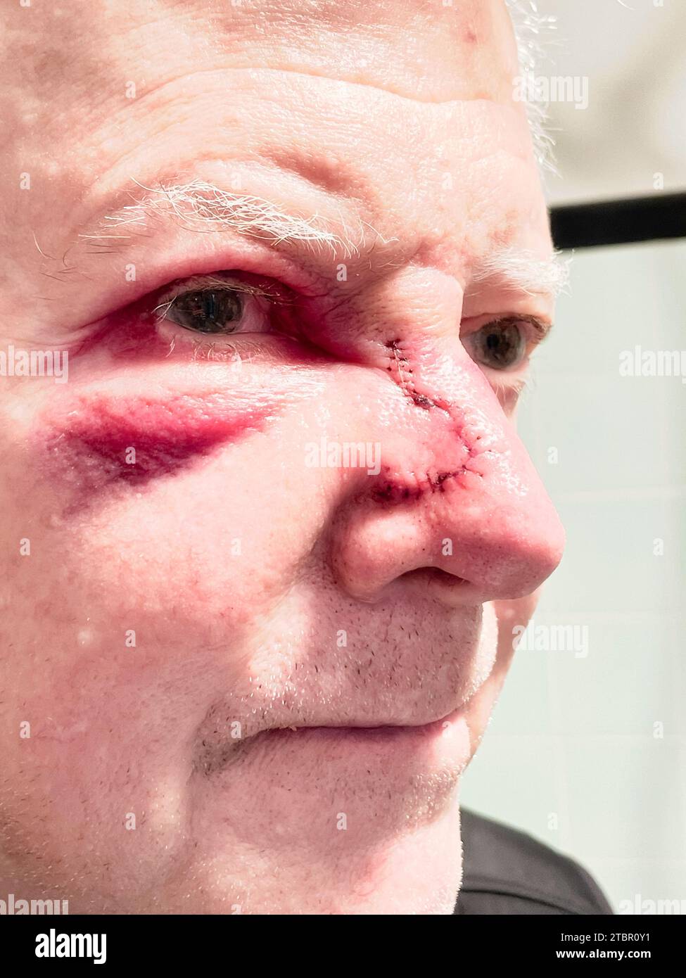 Gros plan d'un homme caucasien âgé avec des points de suture sur le nez, 2023, New York City, USA Banque D'Images