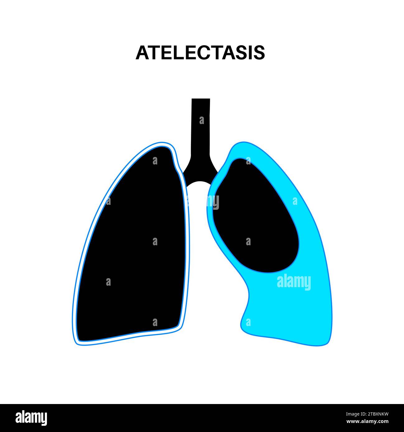 Atélectasie, illustration Banque D'Images