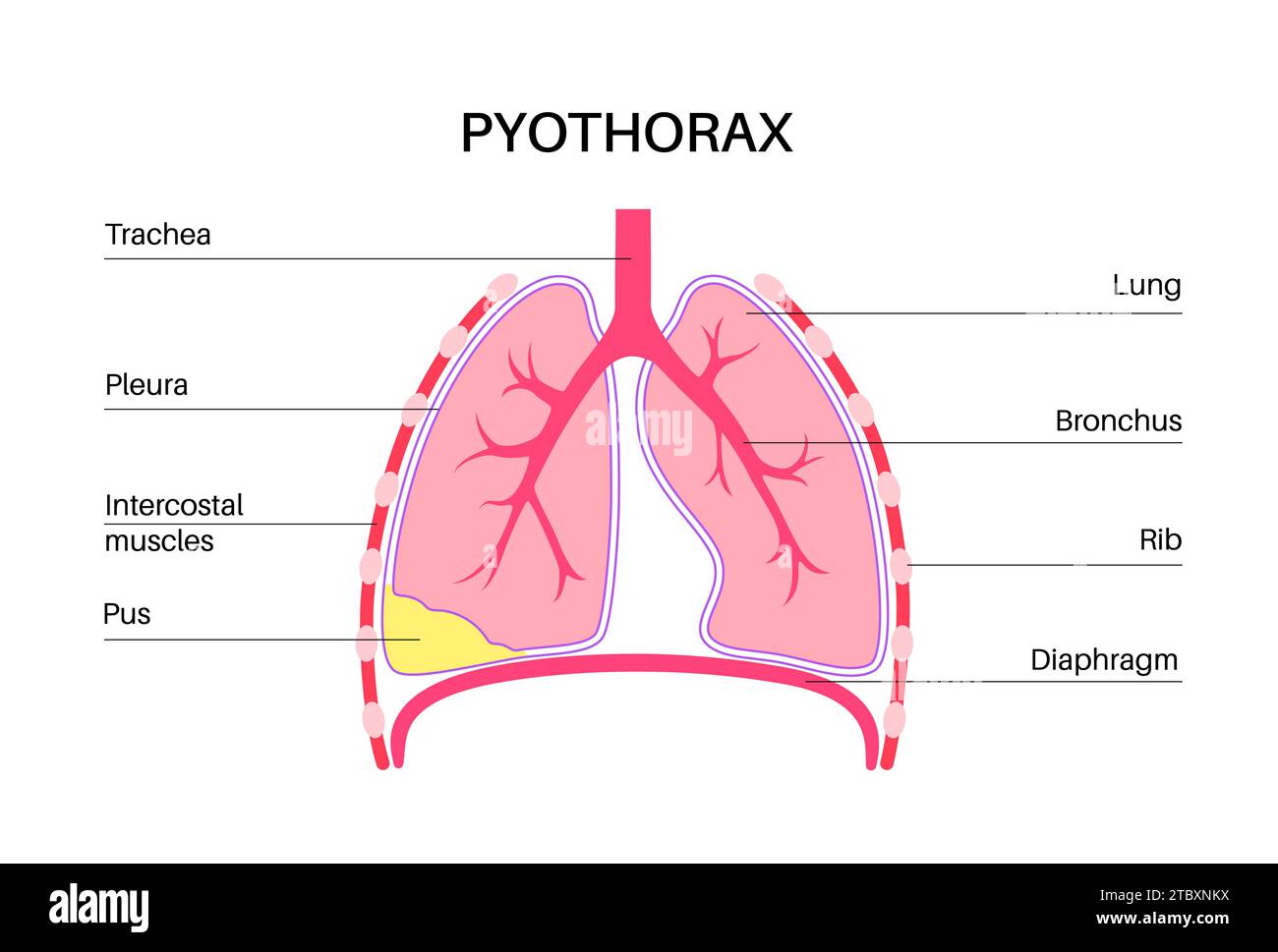 Pyothorax, illustration Banque D'Images