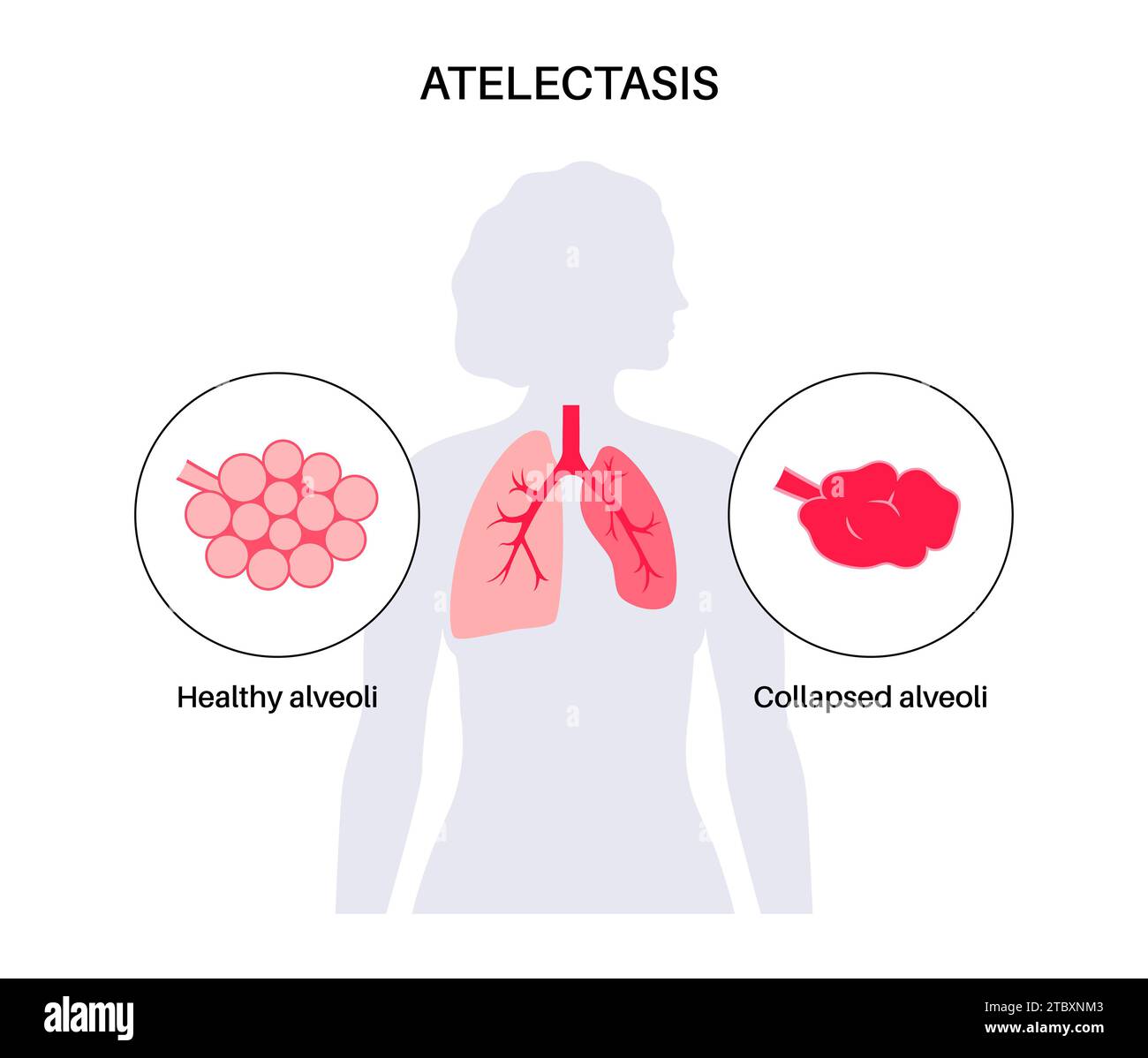Atélectasie, illustration Banque D'Images