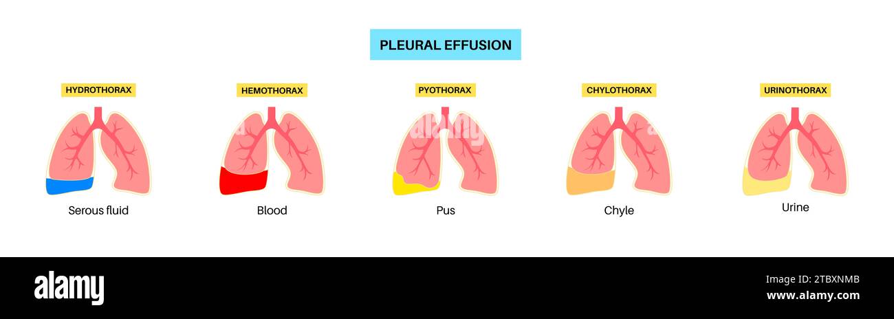 Épanchement pleural, illustration Banque D'Images