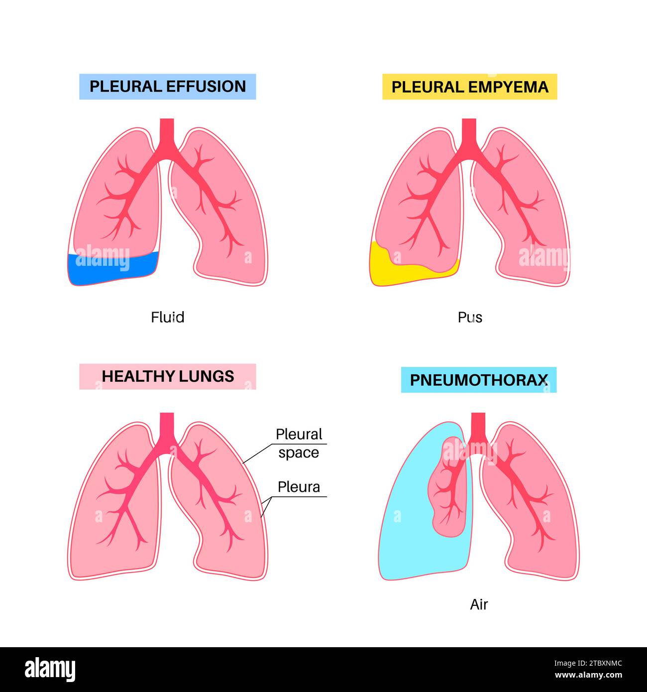 Épanchement pleural, illustration Banque D'Images