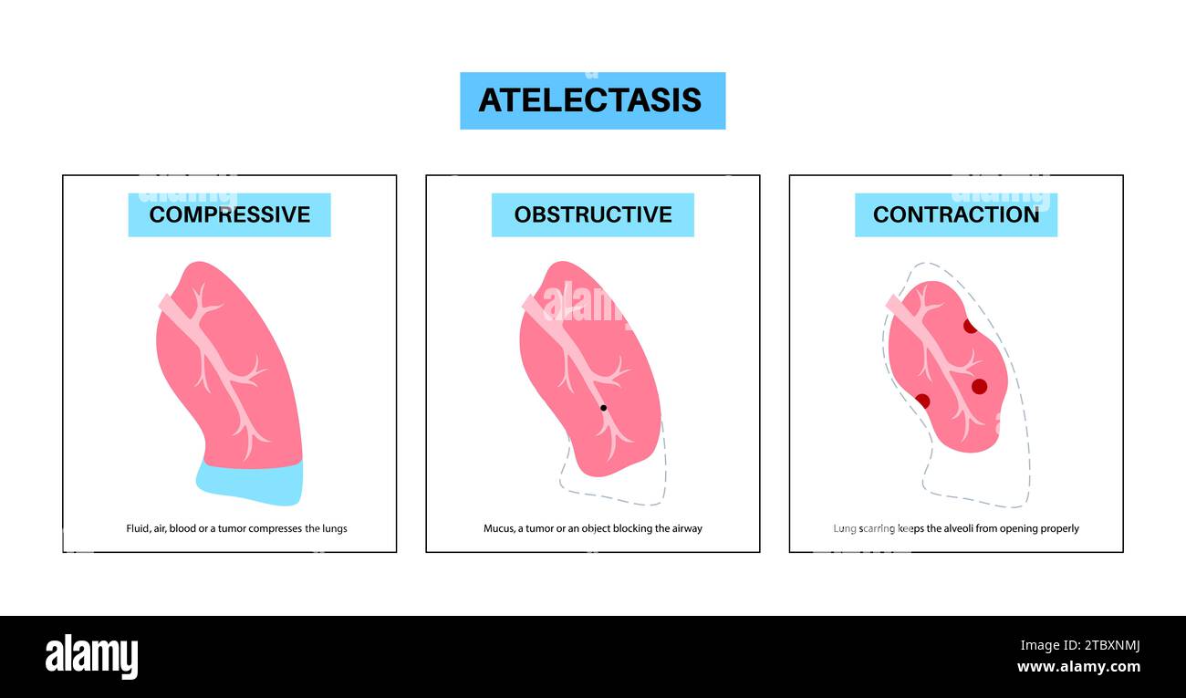 Atélectasie, illustration Banque D'Images