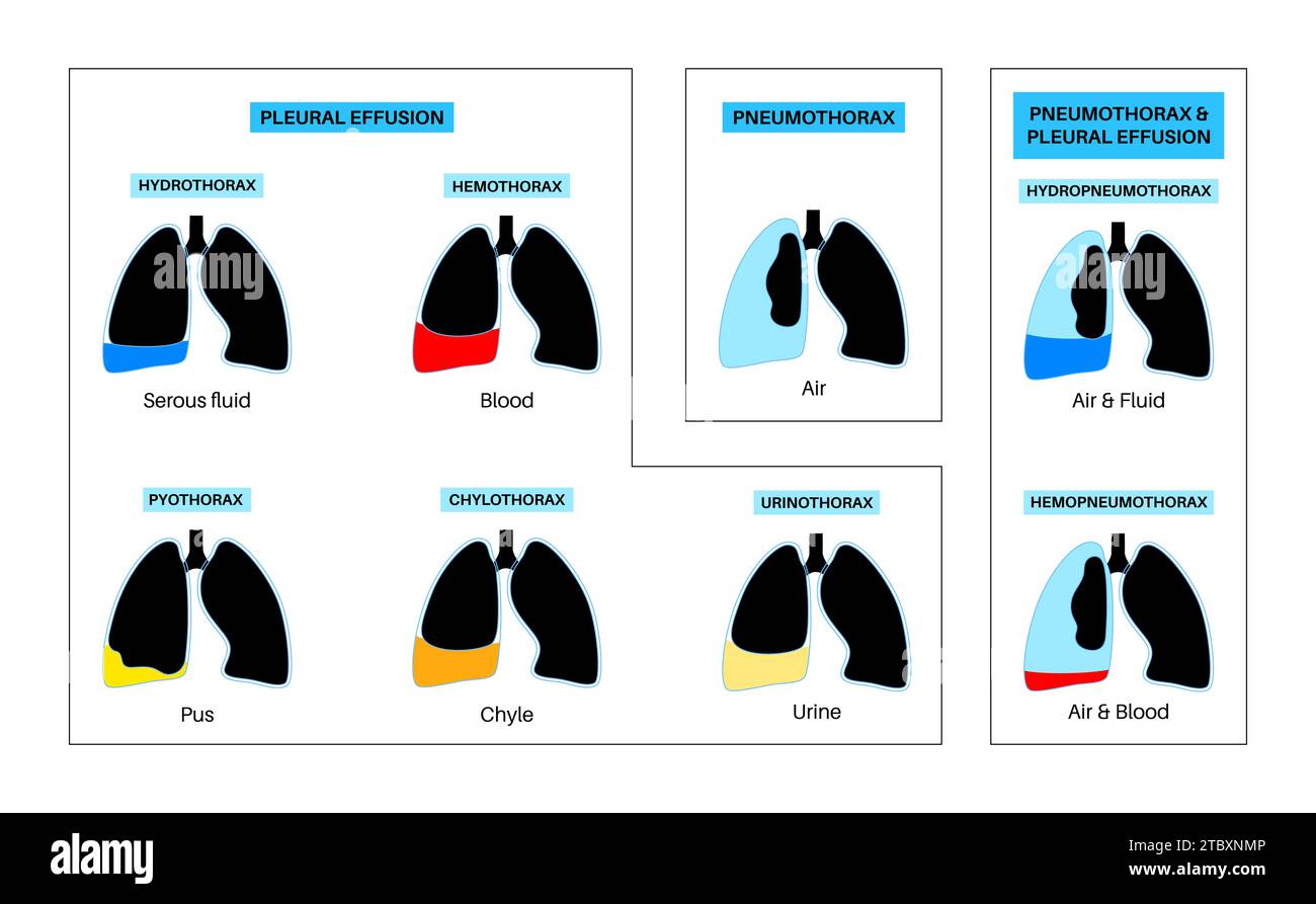 Épanchement pleural, illustration Banque D'Images