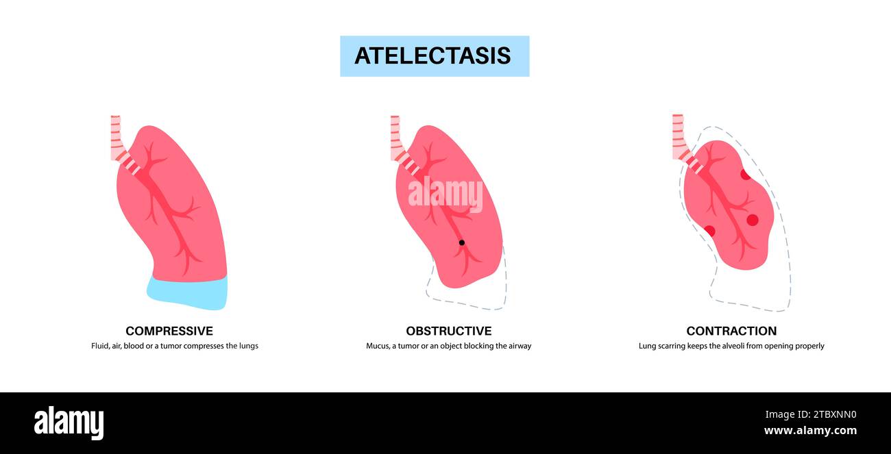Atélectasie, illustration Banque D'Images