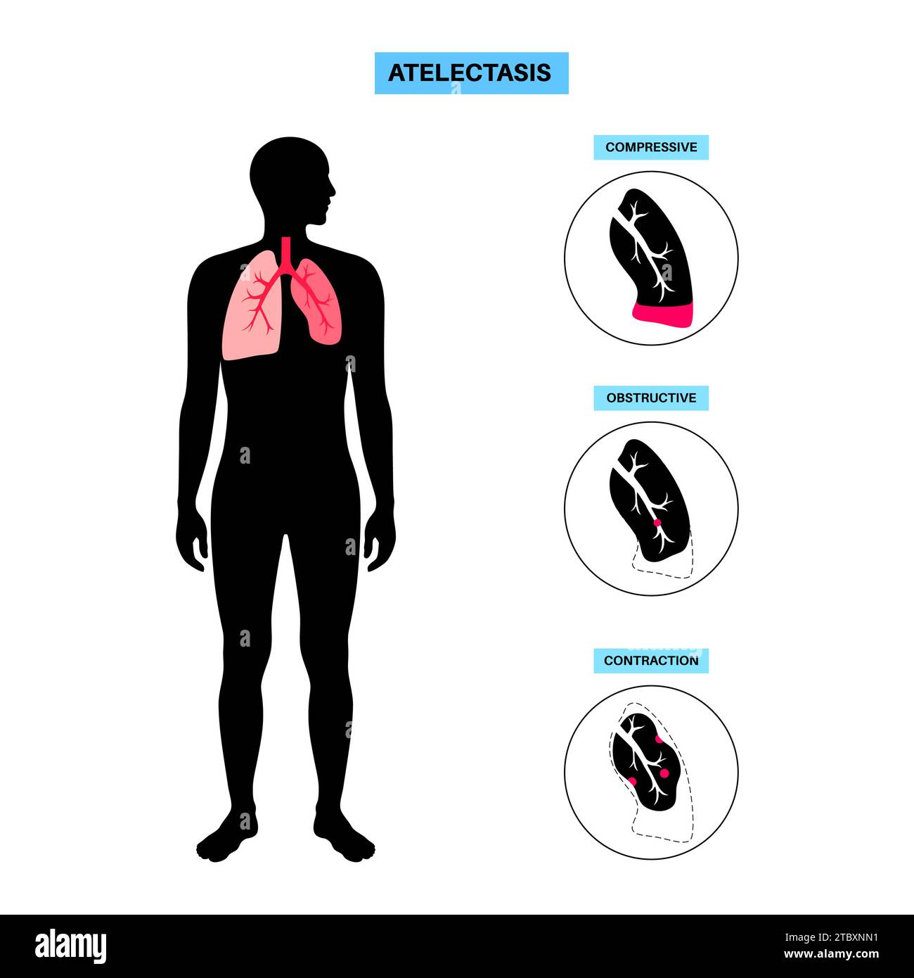Atélectasie, illustration Banque D'Images