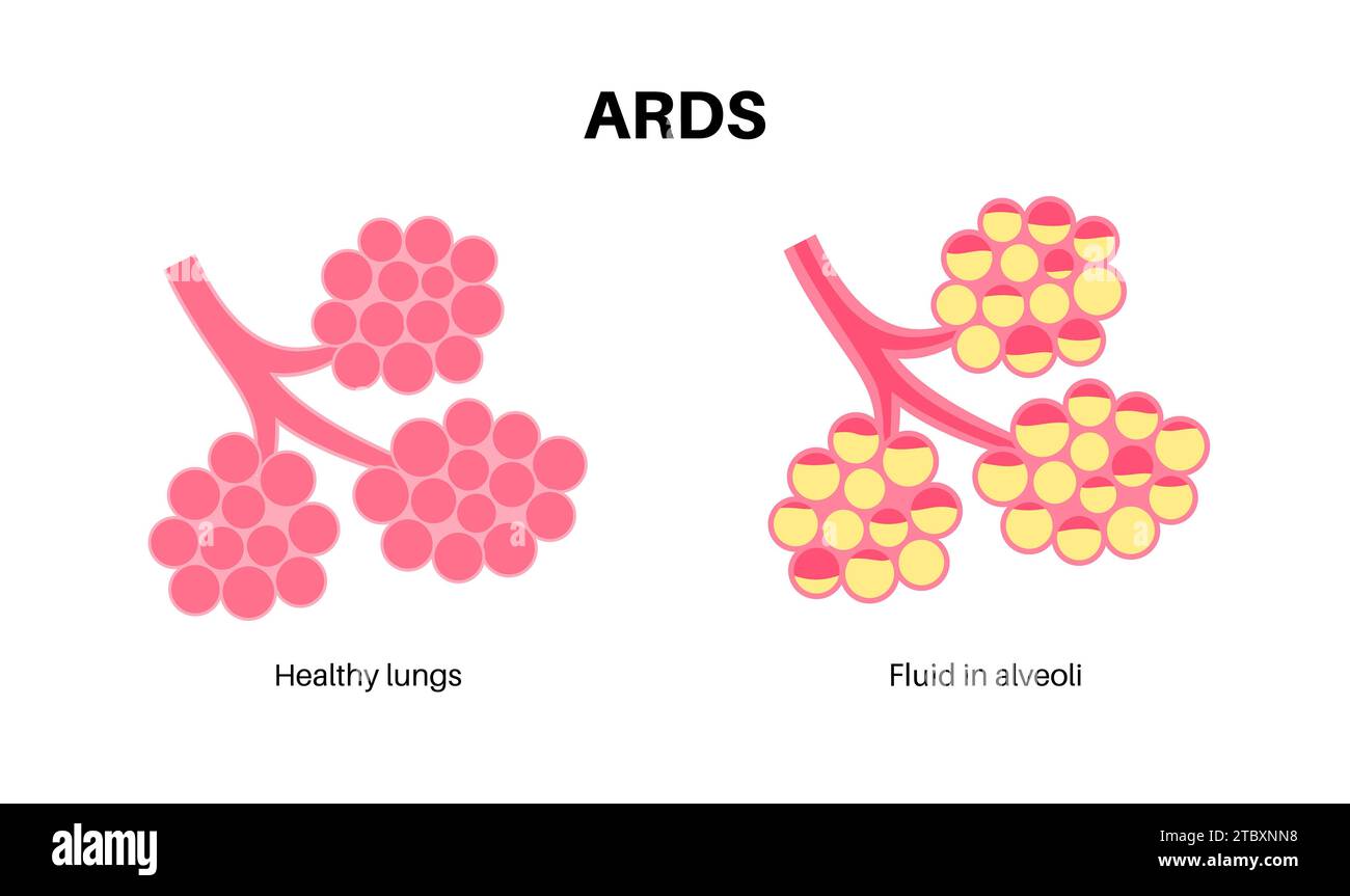 Détresse respiratoire aiguë, illustration Banque D'Images